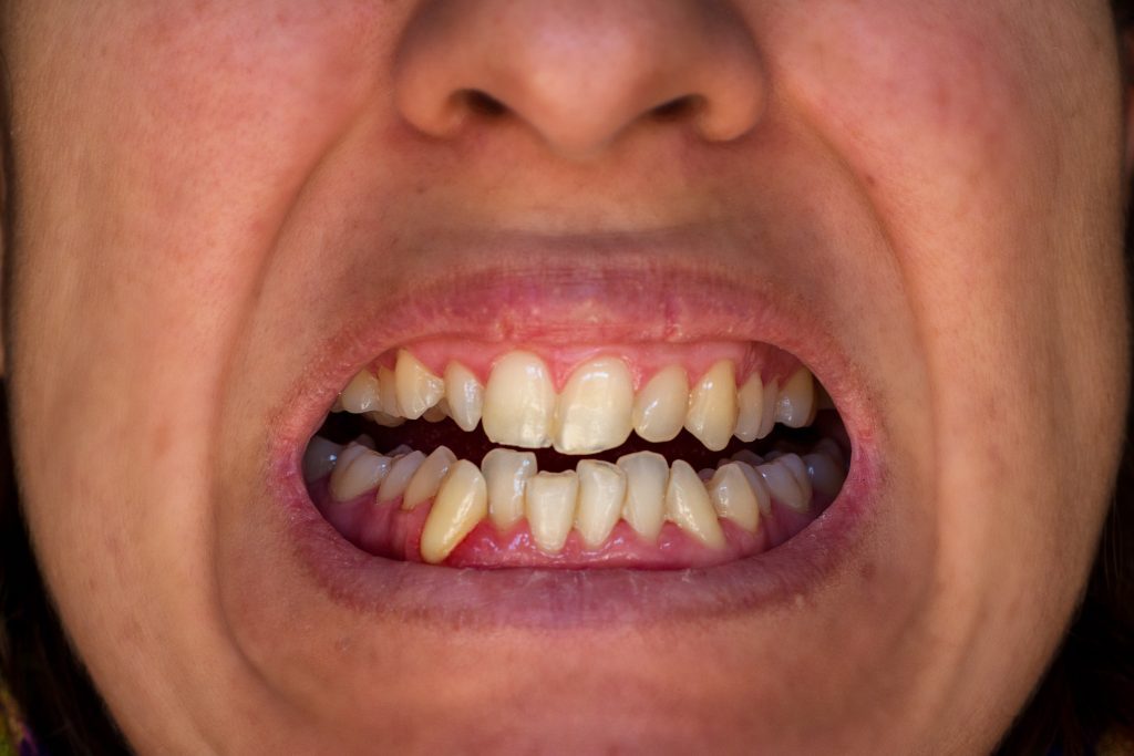 a person has crooked teeth owing to teeth grinding