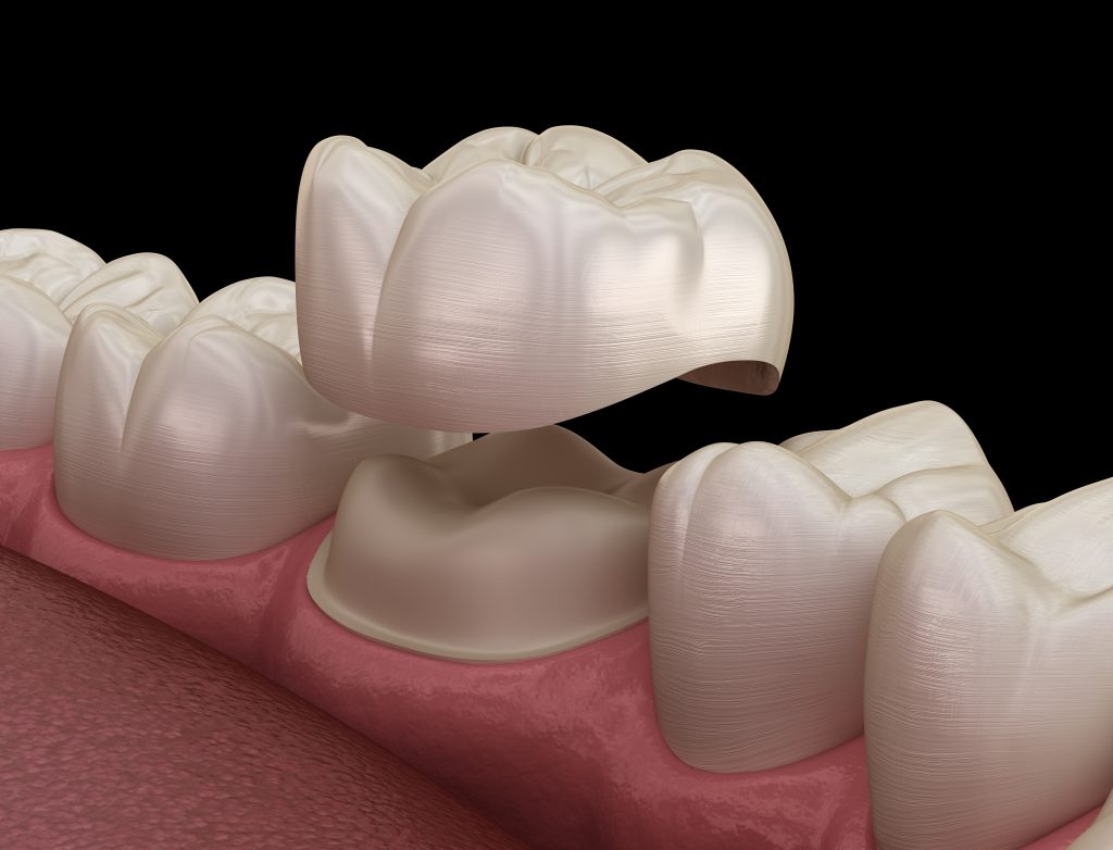 dental crown placed over a tooth